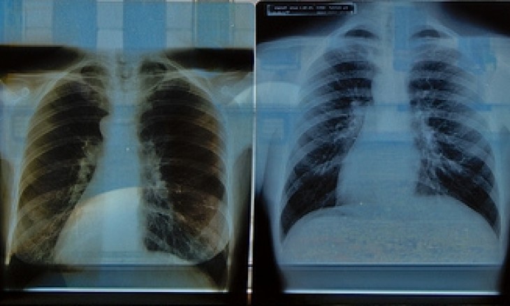 Lungs stricken by black lung disease. Creative Commons
